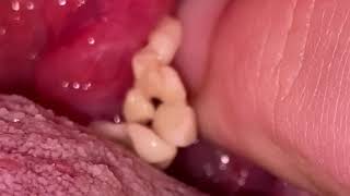 tonsil stones [upl. by Lybis]