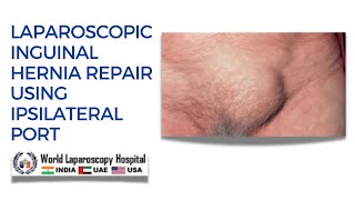 Laparoscopic TAPP Inguinal Hernia Repair Using Ipsilateral Port [upl. by Thornburg57]