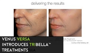 TriBella™ Treatments by Venus Versa™ [upl. by Ecyla]