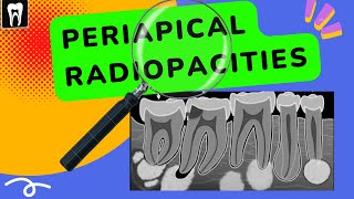 Periapical lesions  Periapical radiopacities  Oral radiology Apical radiopacities [upl. by Eniowtna180]