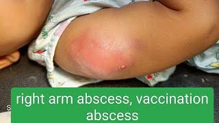 vaccination abscess [upl. by Liag]