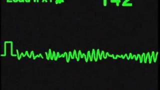 Ventricular Fibrillation  VFIB  ECG Simulator  Arrhythmia Simulator [upl. by Ciredec]