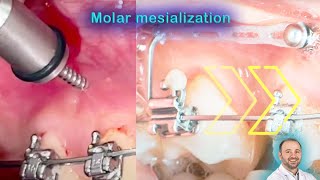 Are TADs really horribly painful from AZ patient experience with mini implants during amp after [upl. by Pastelki]