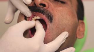 Masking a discolored tooth [upl. by Barrington]