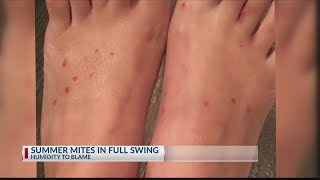 Chigger bite infestation in East Texas [upl. by Roselane]