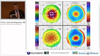 Early Keratoconus diagnosis with Scheimpflug tomography and epithelial mapping [upl. by Narret626]