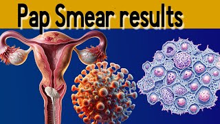 Pap Smear Results Explained under 3 minutes [upl. by Helbonnas]