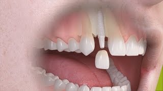 Straumann  Trattamento singolo dente su impianto in ceramica [upl. by Etterrag]