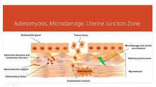 Natural Care for Adenomyosis [upl. by Copland]