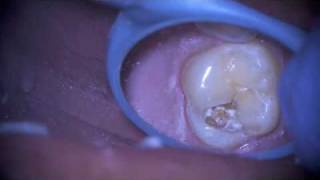 Removal of a Failing Dental Sealant [upl. by Olinad730]