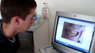 porcelain crowns veneers Tijuana Medical Tourism [upl. by Macario]