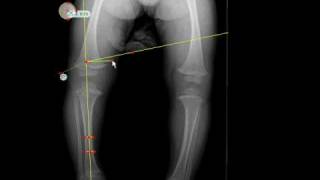 TraumaCad  MetaphysealDiaphyseal Angle [upl. by Ecallaw982]