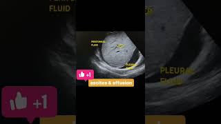 Ascites And Pleural Effusion abdomen usg ascites pleuraleffusion [upl. by Latvina]