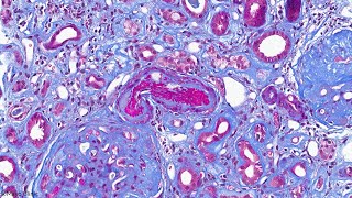 Complement Testing in the Diagnosis and Management of Thrombotic Microangiopathy [upl. by Larkins]