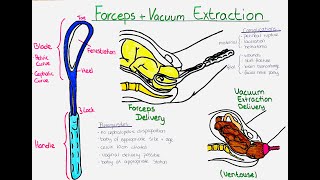 Forceps vs Vacuum Extraction Delivery Ventouse Understanding the Difference Procedures and Risks [upl. by Reyna]