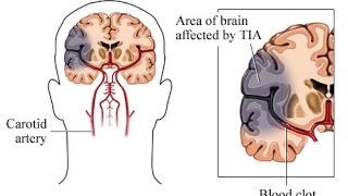 Transient Ischemic Attack TIA [upl. by Bork]