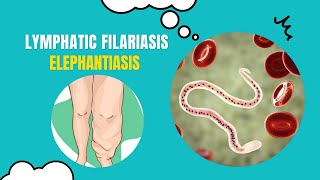 Unlocking the Secrets of Elephantiasis What You Need to Know [upl. by Possing]