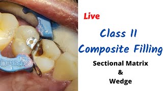 Live Class II Composite Dental Filling Molar amp Premolar with Sectional Matrix amp Wedge [upl. by Baskett]