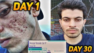 Acne Transformation With Benzyl Peroxide Gel 25  Honest Review [upl. by Ynelram]