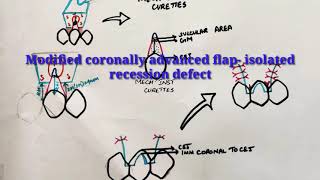 Modified coronally advanced flap isolated recession defect [upl. by Arlette]