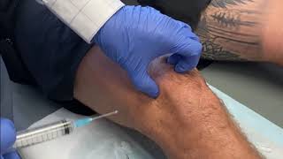 KNEE Intraarticular injection of Local Anaesthetic and Steroid [upl. by Franz855]