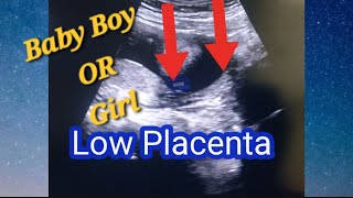 LOW Lying Placenta and Baby Gender ☺️  Posterior Placenta means Baby Girl or Boy  Genderreeal Scan [upl. by Leasa]