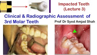 Clinical amp Radiographic Assessment of 3rd Molar  Oral amp Maxillofacial Surgery  Syed Amjad Shah [upl. by Abibah]