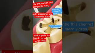 cavity preparation and composite filling Healthopriya [upl. by Mayne]