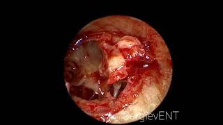 Endoscopic tympanosclerosis and atresia EAC surgery [upl. by Wightman]