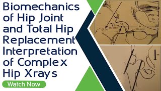 Biomechanics of Hip Joint and Total Hip Replacement  Interpretation of Complex Hip Xrays [upl. by Seiden521]