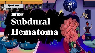 Subdural Hematoma SAH Part 1  Sketchy Medical  USMLE Step 1 [upl. by Aratas733]