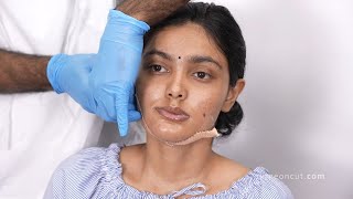 Face Change After Plastic Surgery in India Jaw Surgery Before And After Results [upl. by Maryellen]