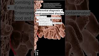 Differential diagnosis of travelassociated diarrhea [upl. by Anahc240]