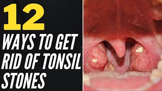 12 Ways To Get Rid Of Tonsil Stones At Home [upl. by Evad]