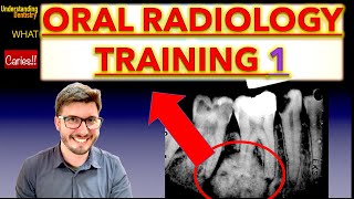 Radiographs Lesion Training Mixed Lesions Periapical X Ray and OPG interpretation dental students [upl. by Downe114]