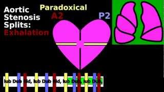 Split S2 Cardiac Auscultation Inspiration Wide Paradoxical Fixed  Pulmonic Aortic Stenosis ASD [upl. by Dylane]