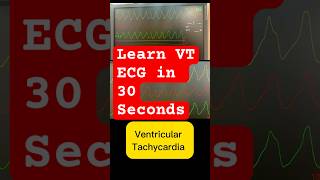 Ventricular tachycardia ecg amp treatment cardiology in 30 seconds [upl. by Rennie]