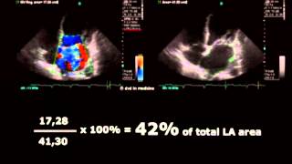 Volodymyr Pavliuk MD PhD Echocardiographic Assesment of Mitral Regurgitation [upl. by Aniakudo42]