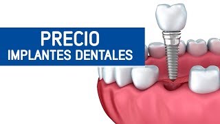 Implantes dentales precio Odontoespecialistas [upl. by Jelene70]