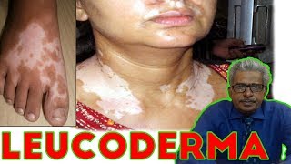 Leucoderma Treatment in Homeopathy by Dr PS Tiwari [upl. by Senaj71]