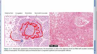 Pathology 465 b BronchoPenumonia Lobular Pneumonia Lung Bronchiole Microscopy Staphylococcus [upl. by Lierbag976]