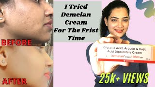 DEMELAN CREAM REVIEW  हिंदी में  My 1 Month Experience With Demelan Cream  Skin Lightening Cream [upl. by Eirffej199]