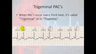 Basic Electrophysiology part 7  Atrial Rhythms part 1 Introduction and PACs [upl. by Dohsar]