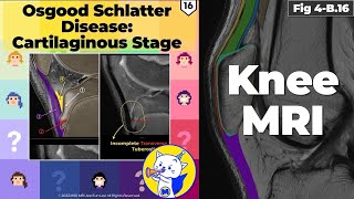 Fig 4B16 Osgood Schlatter Disease Cartilaginous Stage [upl. by Lindblad]