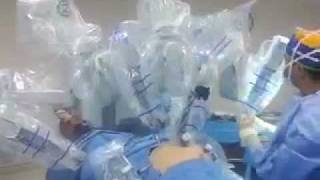 Robotic Rectal Cancer Surgery [upl. by Soisinoid]