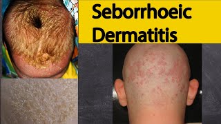 Seborrhoeic dermatitis  Explained under 3 minutes Seborrheic dermatitis Symptoms and treatment [upl. by Navar135]