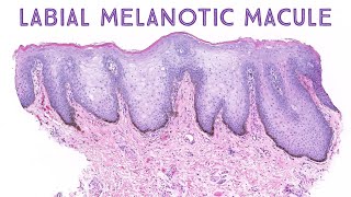 Labial melanotic macule brown spot on lip Stony Brook Case 1 dermatology dermatopathology [upl. by Arabelle]