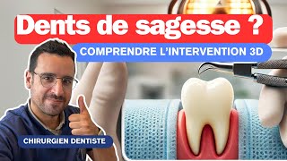 Comprendre l’Extraction DENTS DE SAGESSE [upl. by Nodnrb]