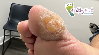 ONE HUGE CALLUS COVERS ENTIRE TOE [upl. by Newmark28]