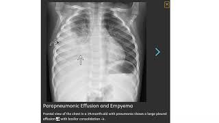 Parapneumonic Effusion and Empyema Imaging [upl. by Eldin]